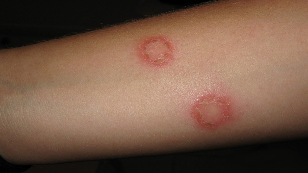 Skin with blister