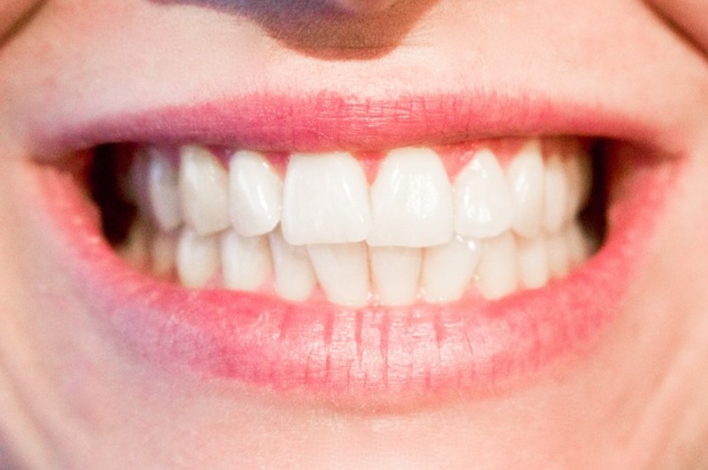 Clean white teeth