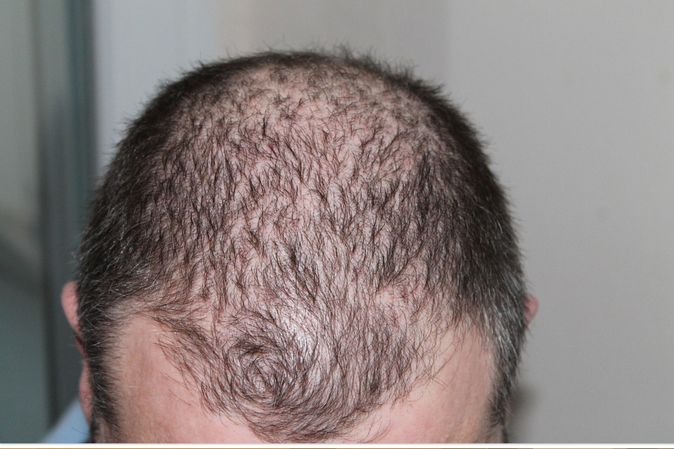 hair loss than needs hair transplant